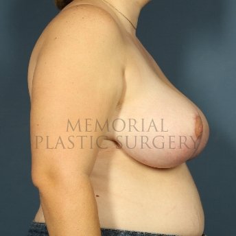 A side view after photo of patient 258 that underwent Breast Reduction procedures at Memorial Plastic Surgery