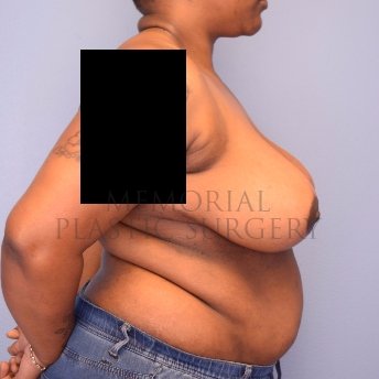 A side view after photo of patient 1243 that underwent Breast Reduction procedures at Memorial Plastic Surgery