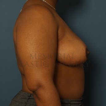 A side view after photo of patient 250 that underwent Breast Reduction procedures at Memorial Plastic Surgery