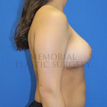 A side view after photo of patient 1515 that underwent Breast Reduction procedures at Memorial Plastic Surgery