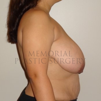A side view before photo of patient 197 that underwent Breast Reduction procedures at Memorial Plastic Surgery
