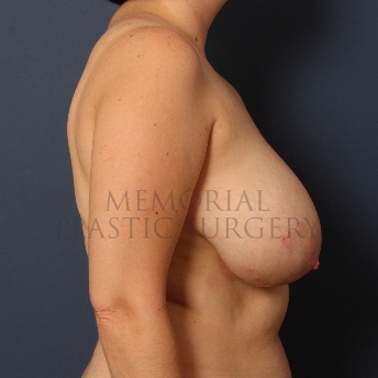 A side view before photo of patient 245 that underwent Breast Reduction procedures at Memorial Plastic Surgery