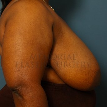 A side view before photo of patient 244 that underwent Breast Reduction procedures at Memorial Plastic Surgery