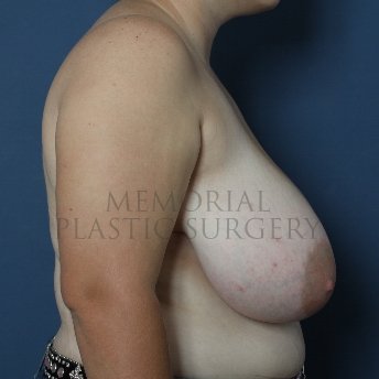 A side view before photo of patient 258 that underwent Breast Reduction procedures at Memorial Plastic Surgery