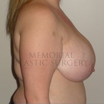 A side view before photo of patient 200 that underwent Breast Reduction procedures at Memorial Plastic Surgery