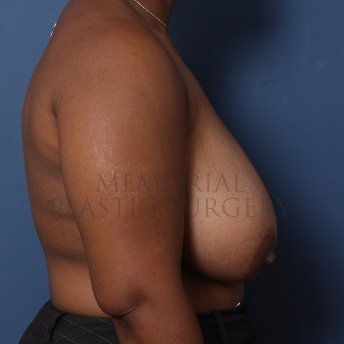 A side view before photo of patient 250 that underwent Breast Reduction procedures at Memorial Plastic Surgery