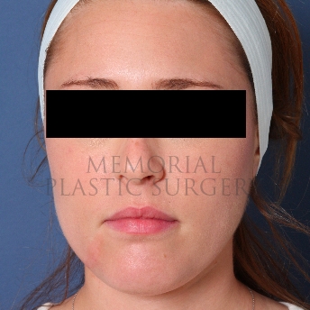 A front view after photo of patient 208 that underwent Buccal Fat Removal procedures at Memorial Plastic Surgery