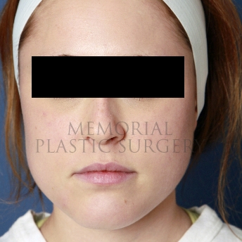 A front view before photo of patient 208 that underwent Buccal Fat Removal procedures at Memorial Plastic Surgery