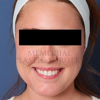 A oblique view after photo of patient 208 that underwent Buccal Fat Removal procedures at Memorial Plastic Surgery
