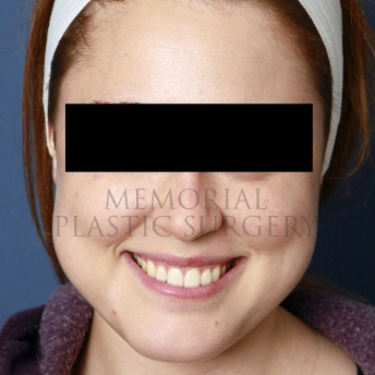 A oblique view before photo of patient 208 that underwent Buccal Fat Removal procedures at Memorial Plastic Surgery