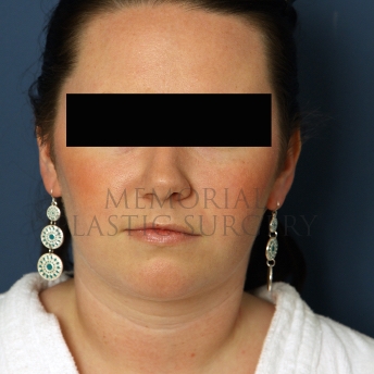 A front view after photo of patient 326 that underwent Chin Lipo procedures at Memorial Plastic Surgery