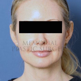 A front view after photo of patient 287 that underwent Chin Lipo procedures at Memorial Plastic Surgery