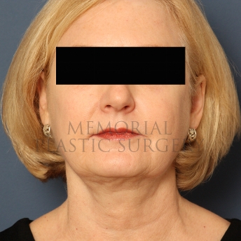 A front view after photo of patient 347 that underwent Chin Lipo procedures at Memorial Plastic Surgery