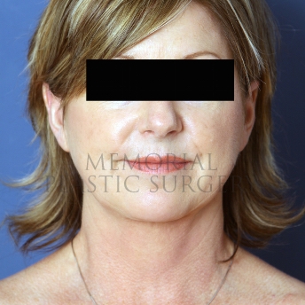 A front view after photo of patient 311 that underwent Chin Lipo procedures at Memorial Plastic Surgery