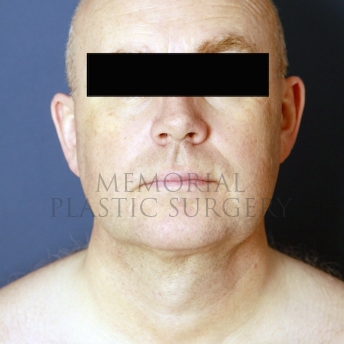 A front view after photo of patient 397 that underwent Chin Lipo procedures at Memorial Plastic Surgery