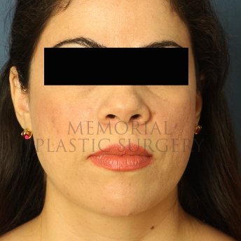A front view after photo of patient 313 that underwent Chin Lipo procedures at Memorial Plastic Surgery