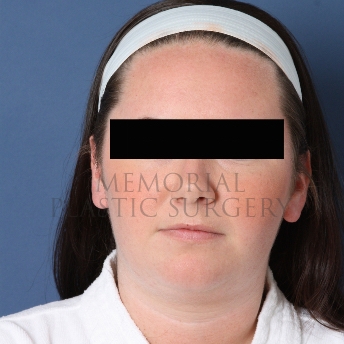 A front view before photo of patient 326 that underwent Chin Lipo procedures at Memorial Plastic Surgery