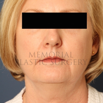 A front view before photo of patient 347 that underwent Chin Lipo procedures at Memorial Plastic Surgery