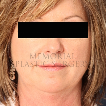 A front view before photo of patient 311 that underwent Chin Lipo procedures at Memorial Plastic Surgery