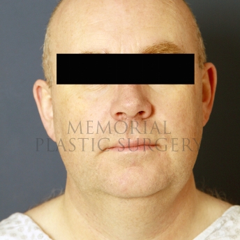 A front view before photo of patient 397 that underwent Chin Lipo procedures at Memorial Plastic Surgery