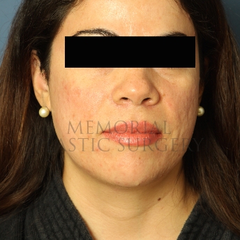 A front view before photo of patient 313 that underwent Chin Lipo procedures at Memorial Plastic Surgery