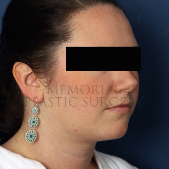 A oblique view after photo of patient 326 that underwent Chin Lipo procedures at Memorial Plastic Surgery