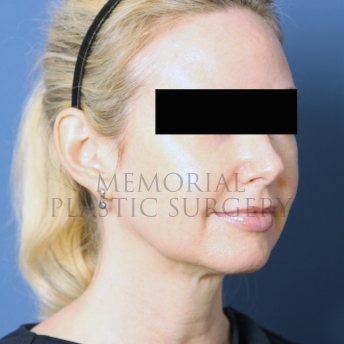 A oblique view after photo of patient 287 that underwent Chin Lipo procedures at Memorial Plastic Surgery