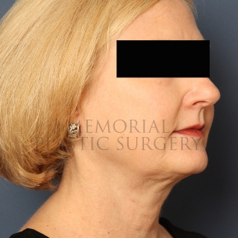 A oblique view after photo of patient 347 that underwent Chin Lipo procedures at Memorial Plastic Surgery