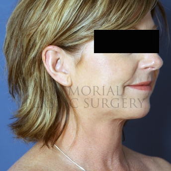 A oblique view after photo of patient 311 that underwent Chin Lipo procedures at Memorial Plastic Surgery