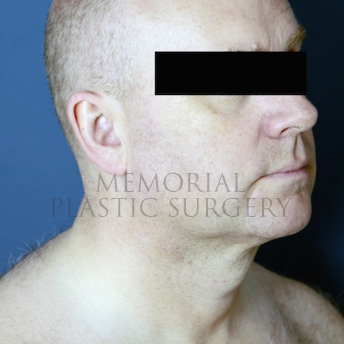 A oblique view after photo of patient 397 that underwent Chin Lipo procedures at Memorial Plastic Surgery