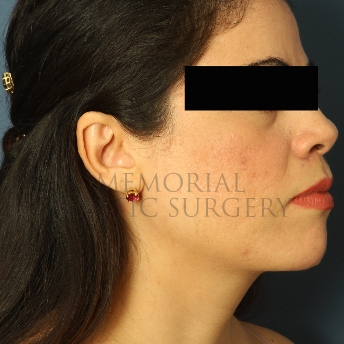 A oblique view after photo of patient 313 that underwent Chin Lipo procedures at Memorial Plastic Surgery