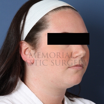 A oblique view before photo of patient 326 that underwent Chin Lipo procedures at Memorial Plastic Surgery