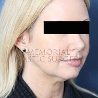 A oblique view before photo of patient 287 that underwent Chin Lipo procedures at Memorial Plastic Surgery