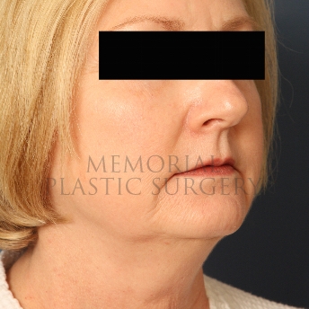 A oblique view before photo of patient 347 that underwent Chin Lipo procedures at Memorial Plastic Surgery