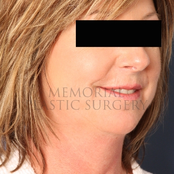 A oblique view before photo of patient 311 that underwent Chin Lipo procedures at Memorial Plastic Surgery