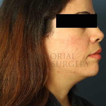 A oblique view before photo of patient 313 that underwent Chin Lipo procedures at Memorial Plastic Surgery