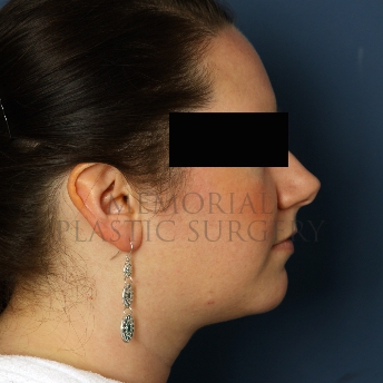 A side view after photo of patient 326 that underwent Chin Lipo procedures at Memorial Plastic Surgery