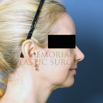 A side view after photo of patient 287 that underwent Chin Lipo procedures at Memorial Plastic Surgery