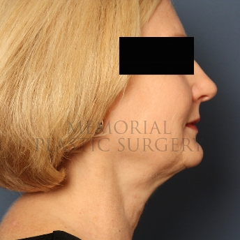 A side view after photo of patient 347 that underwent Chin Lipo procedures at Memorial Plastic Surgery