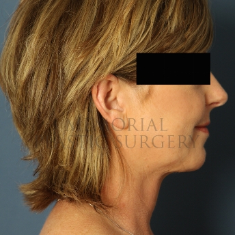 A side view after photo of patient 311 that underwent Chin Lipo procedures at Memorial Plastic Surgery