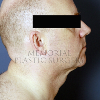 A side view after photo of patient 397 that underwent Chin Lipo procedures at Memorial Plastic Surgery