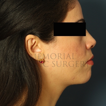A side view after photo of patient 313 that underwent Chin Lipo procedures at Memorial Plastic Surgery
