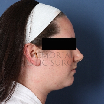 A side view before photo of patient 326 that underwent Chin Lipo procedures at Memorial Plastic Surgery
