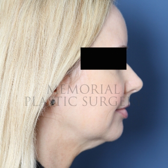 A side view before photo of patient 287 that underwent Chin Lipo procedures at Memorial Plastic Surgery