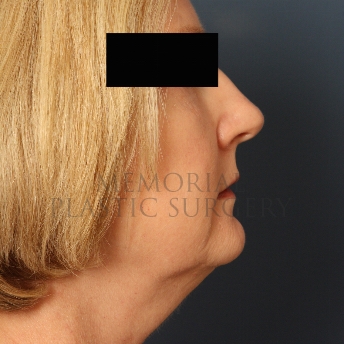 A side view before photo of patient 347 that underwent Chin Lipo procedures at Memorial Plastic Surgery