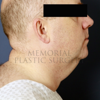 A side view before photo of patient 397 that underwent Chin Lipo procedures at Memorial Plastic Surgery