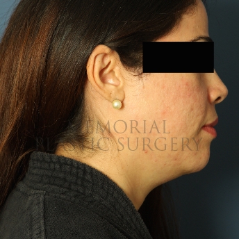A side view before photo of patient 313 that underwent Chin Lipo procedures at Memorial Plastic Surgery