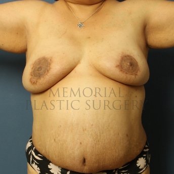 A front view after photo of patient 380 that underwent DIEP Flap Surgery procedures at Memorial Plastic Surgery