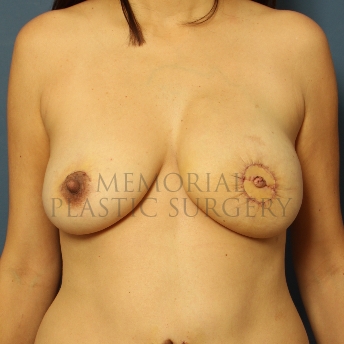 A front view after photo of patient 358 that underwent DIEP Flap Surgery procedures at Memorial Plastic Surgery