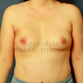 A front view after photo of patient 314 that underwent DIEP Flap Surgery procedures at Memorial Plastic Surgery